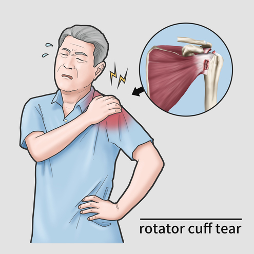 Upper extremity injuries