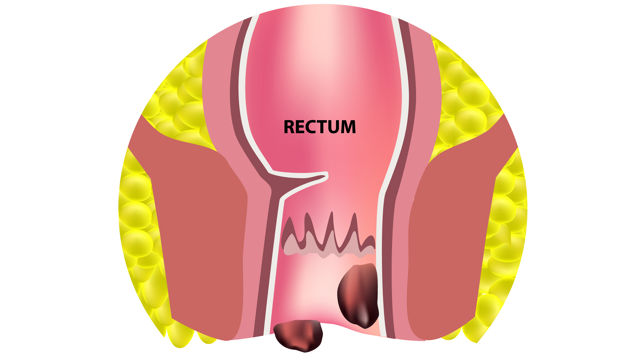 Hemorrhoidectomy is a surgical procedure to remove hemorrhoids, which are swollen and inflamed veins in the lower rectum and anus. The procedure involves removing the affected tissue, either through traditional surgery or minimally invasive techniques such as laser surgery.