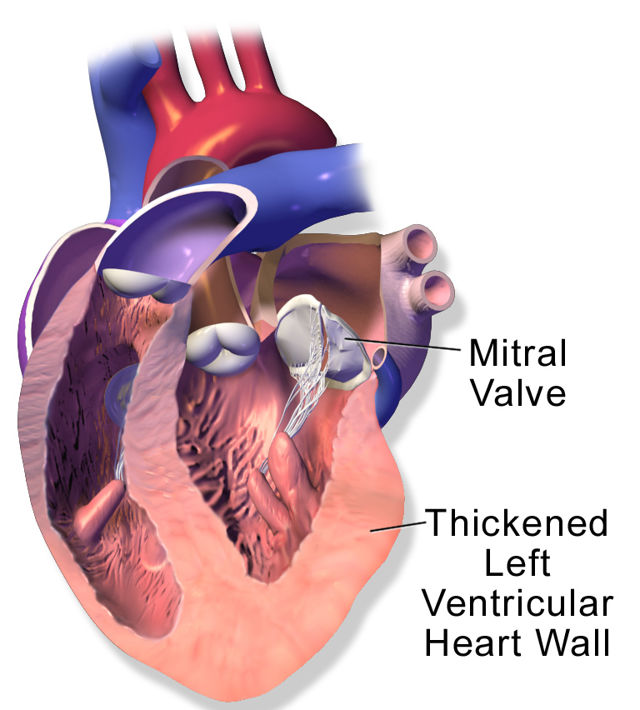 Hypertrophic Cardiomyopathy