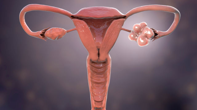 Pathophysiology of endometrial hyperplasia