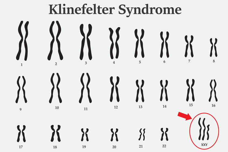 Clinical Features Diagnosis And Management Of Klinefelter Syndrome