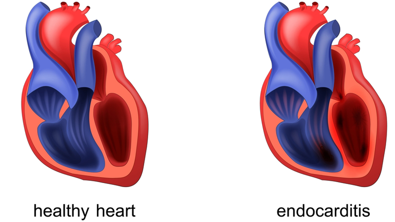 Aortic Regurgitation - Symptoms Diagnosis, and Management