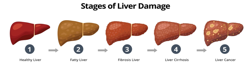 Cirrhosis