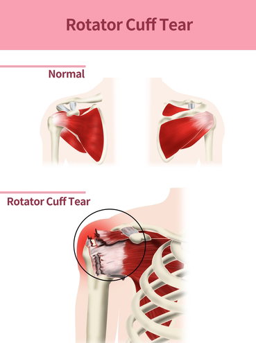 Rotator Cuff Tear: When to Repair and When to Smooth and Move the Shoulder