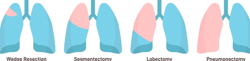 Types of Lung Surgeries