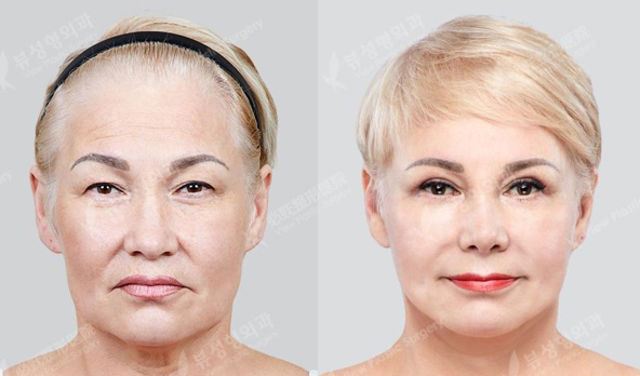 Before and after face contouring surgery
