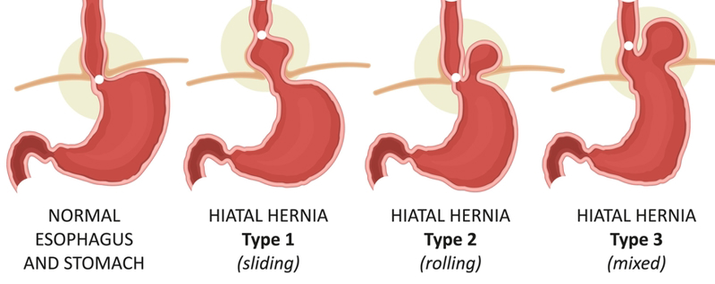 Stomach Hernias