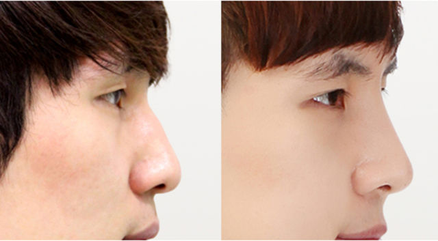 До и после операции на орлином носу