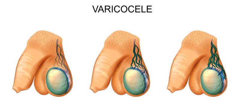 Varicoceles Causes