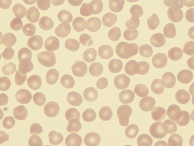 Hereditary Spherocytosis In Kids