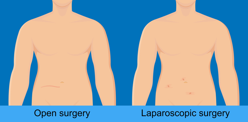 Laparoscopic & Open Surgery