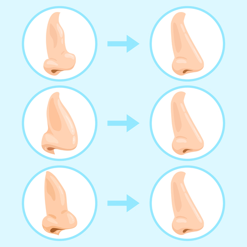 Типы кривого носа