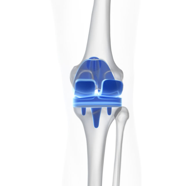 Types of Elbow Implant