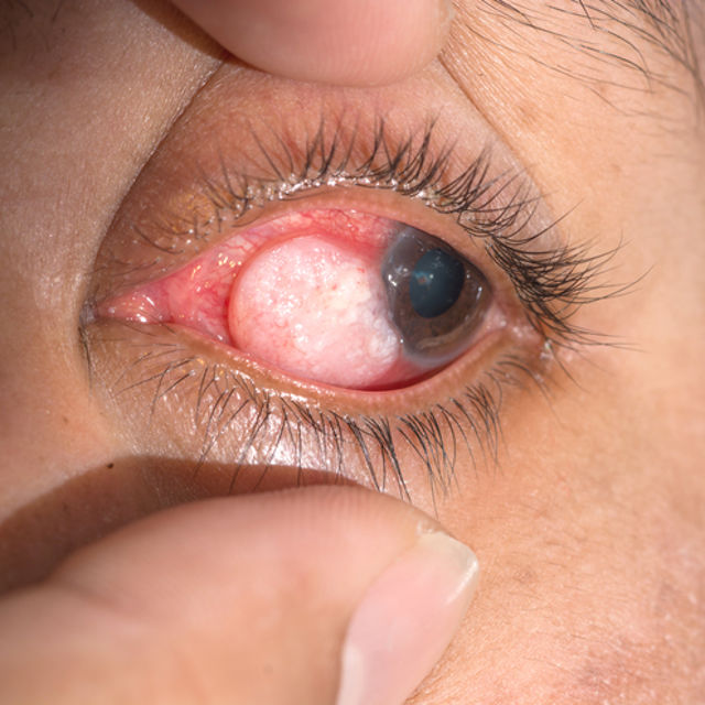 tratamiento de tumores oculares