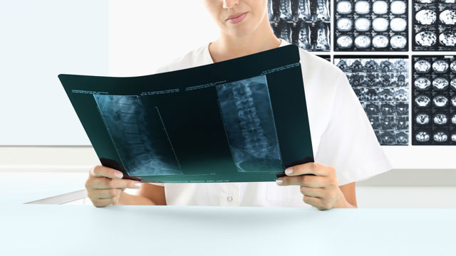 Radiographie de la tumeur de la colonne vertébrale 