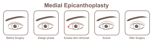 การผ่าตัดกระดูกแก้มในบริเวณในตา (Medial Epicanthoplasty)