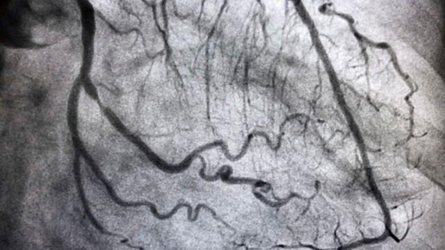 Procedimiento de angiografía coronaria