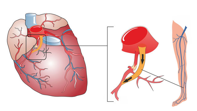 Surgical Procedures For Heart