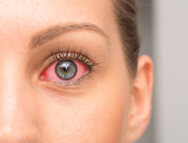 симптомы синдрома сухого глаза