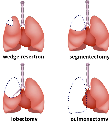 Lung Resection