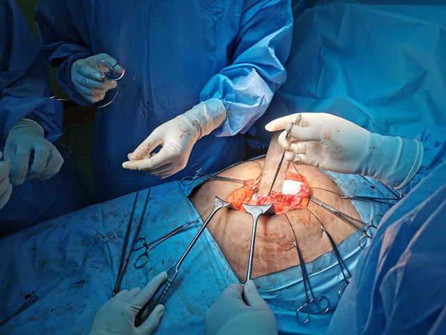 cirugía de reparación de hernias