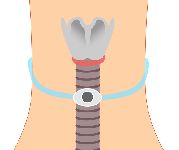 tracheal stenosis treatment 