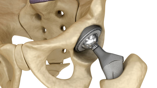 coxarthrosis jelentése magyarul