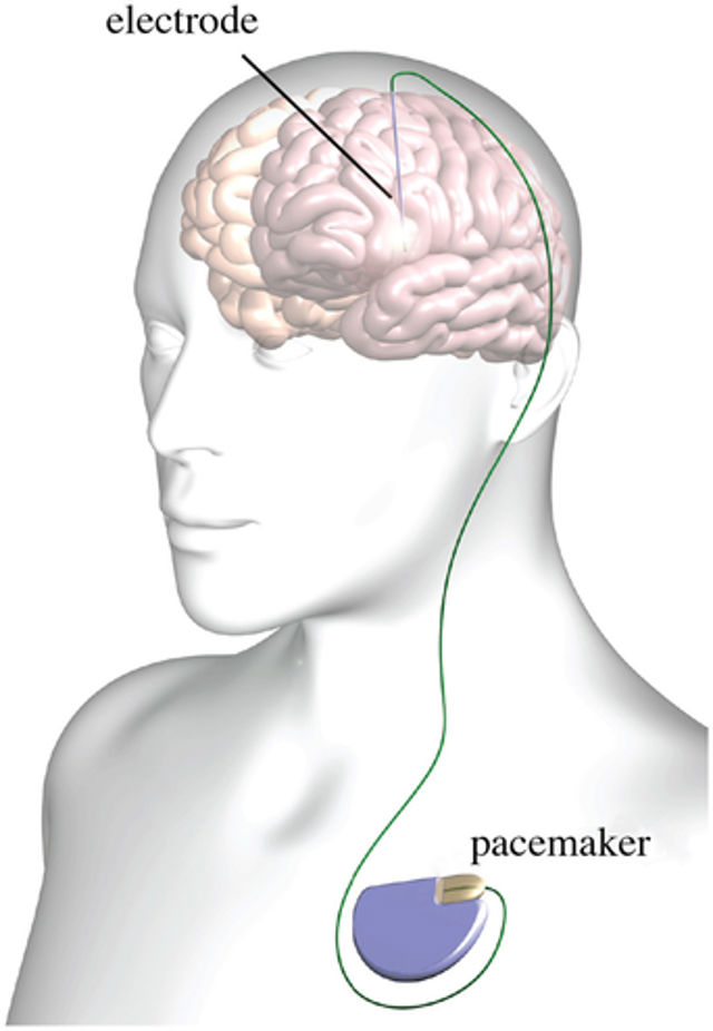 Cirugía de estimulación cerebral profunda