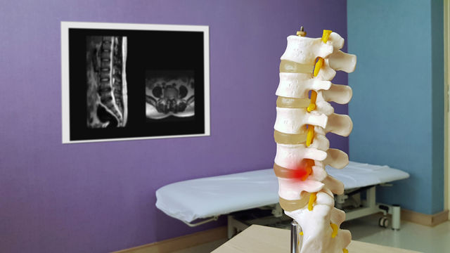 Resonancia magnética del tumor espinal