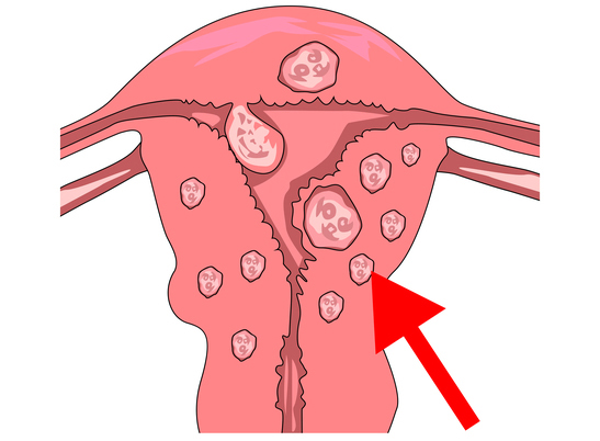 fibroid-removal-hysteroscopy