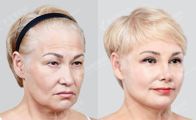 Before and after face contouring surgery