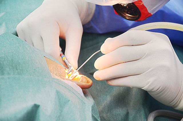 Tympanoplasty Surgery