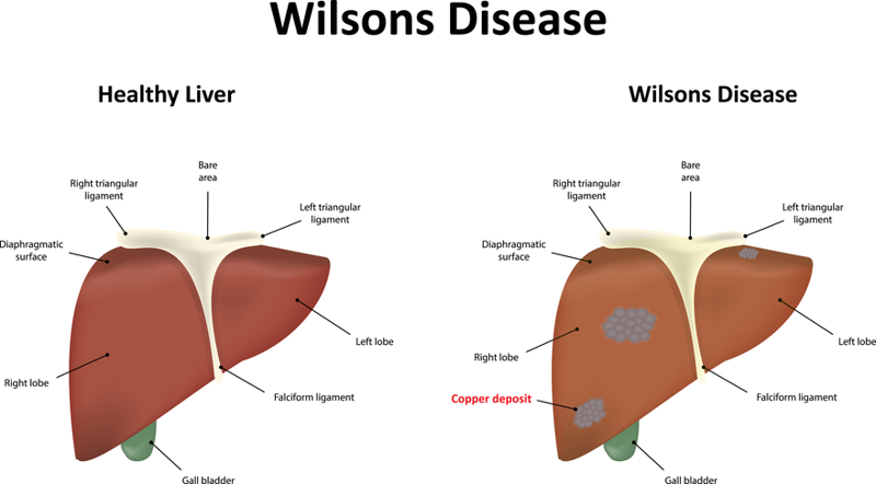 Wilson disease