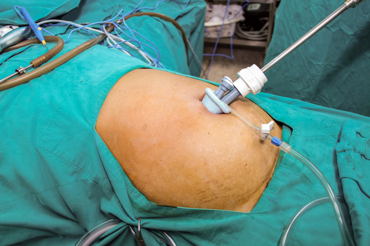laparoscopic Surgical Procedure