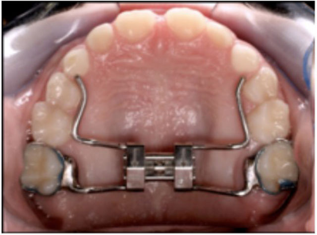 5-Removable-orthodontic-appliance-807851d7-5d43-4062-91a9-09ce613dcab2.jpg
