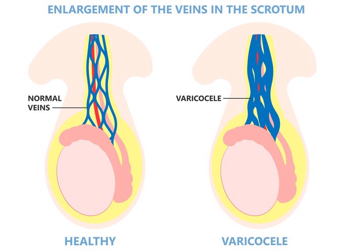 varicocele occur