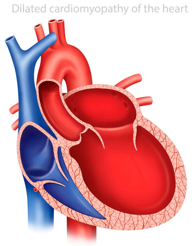 Hypertrophic cardiomyopathy