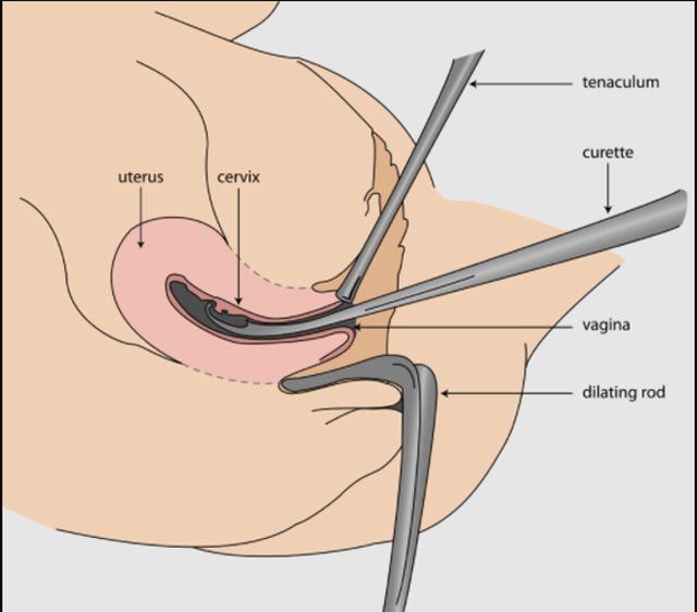 Diagnosis of endometrial hyperplasia 