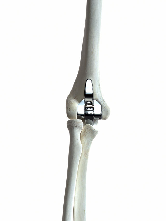 elbow implants advantages and disadvantages
