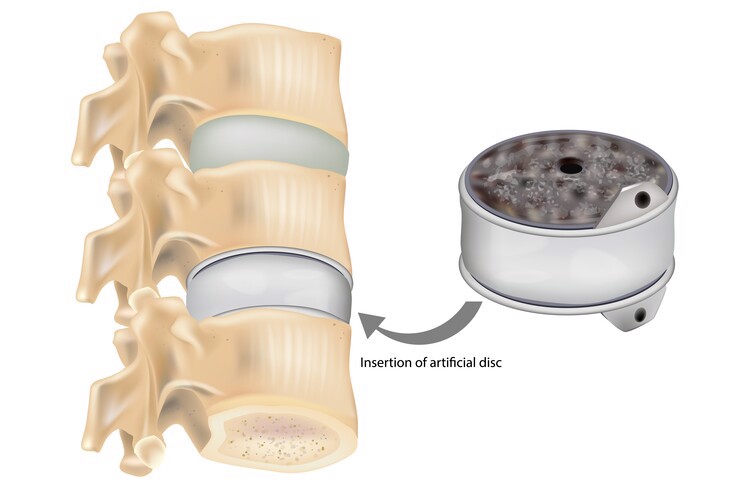 How is Cervical Disc Replacement Performed?