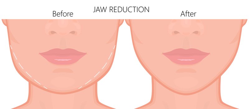 Jaw Botox injections
