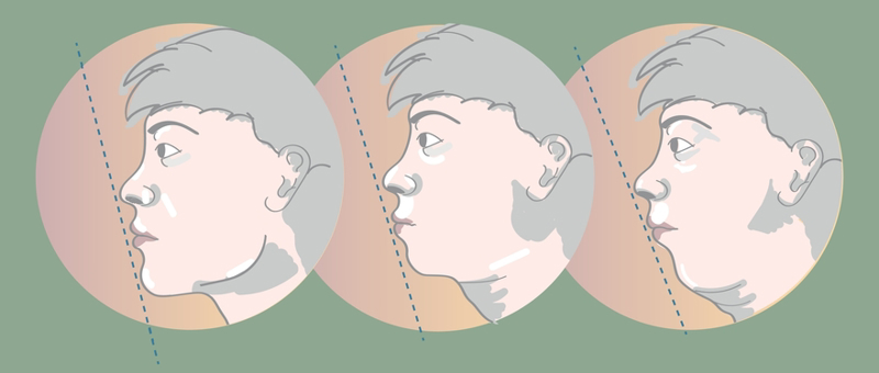 Corrective Jaw (Orthognathic) Surgery Cost by Countries