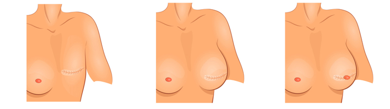 breast reconstruction method