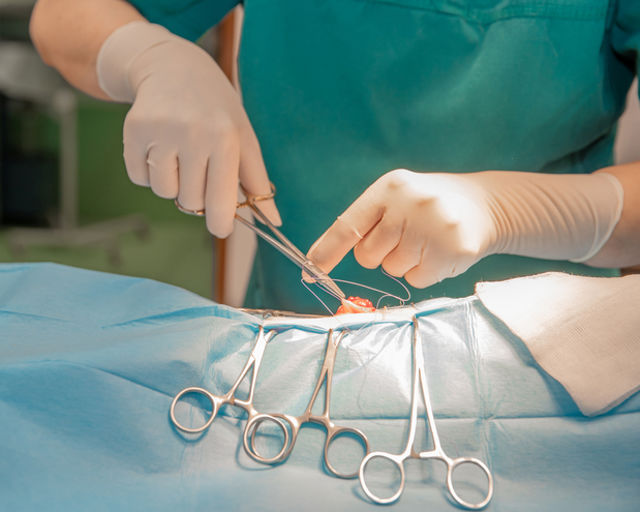 Cholangiocarcinoma surgery