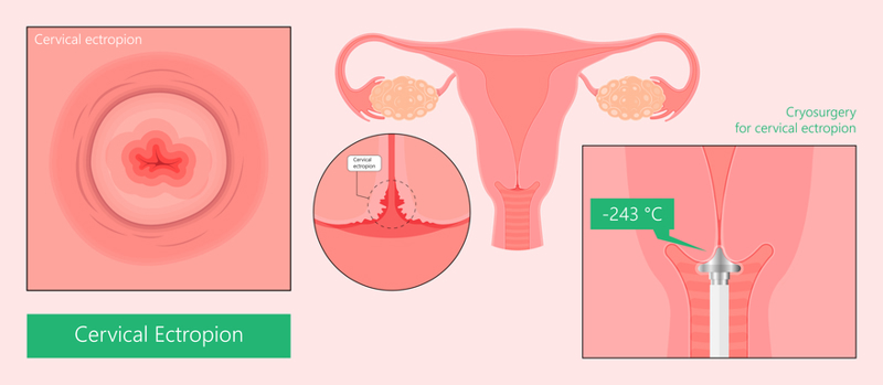 Cervical cryosurgery chart