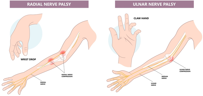 Common peripheral nerve injuries