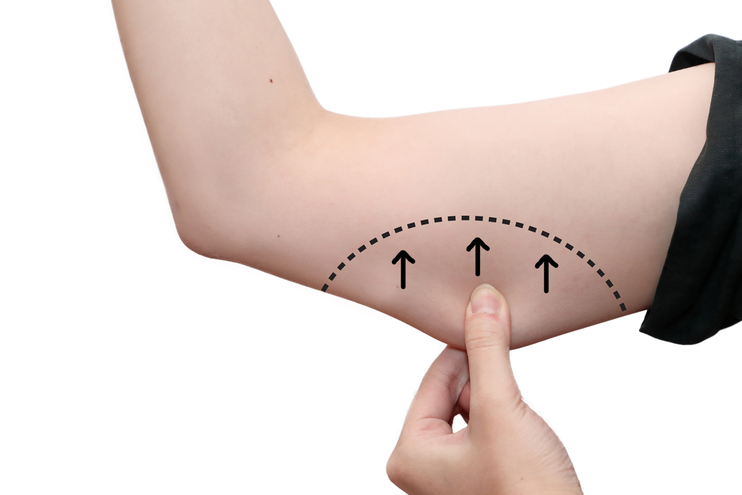 Liposuction arms