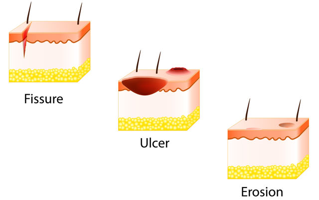 what-you-didn-t-know-about-skin-lesions