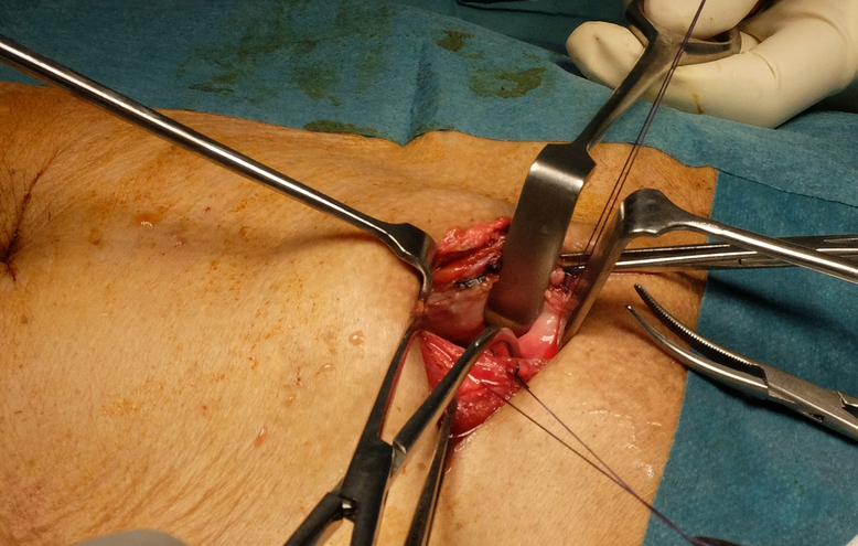 phẫu thuật cắt bàng quang