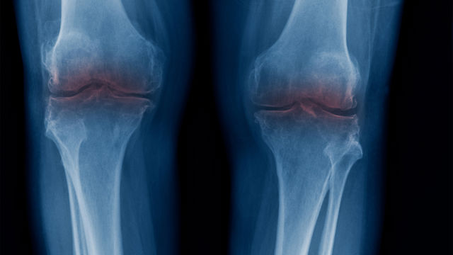 Diagnostic d'arthrite dégénérative